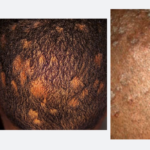 Read more about the article Tinea Capitis – Ringworm of the scalp