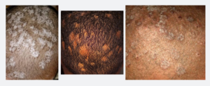 Read more about the article Tinea Capitis – Ringworm of the scalp