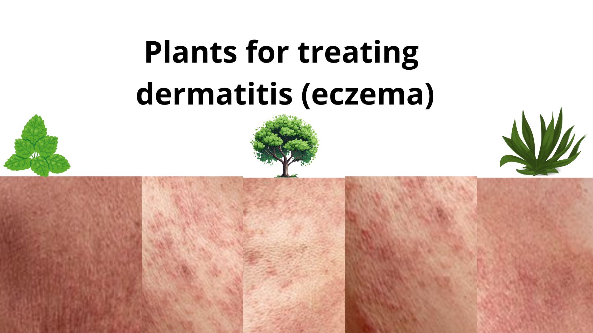 Plants for treating eczema