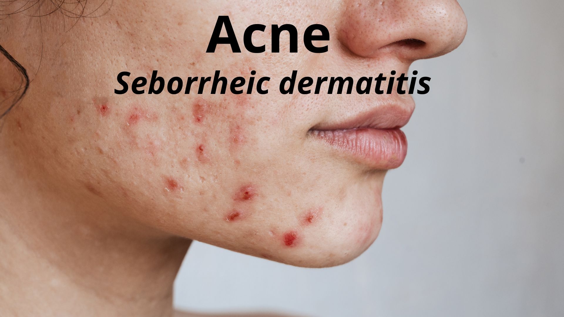 You are currently viewing Acne (Seborrheic dermatitis)